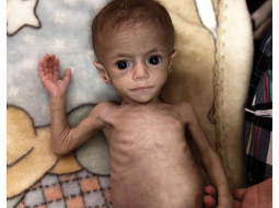 Sešus mēnešus vecā palestīniešu meitenīte Sivara Ašura cieš no pārtikas trūkuma.